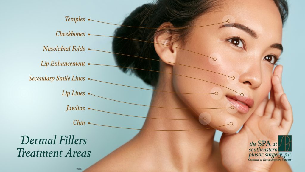 Diagram of areas dermal fillers treat