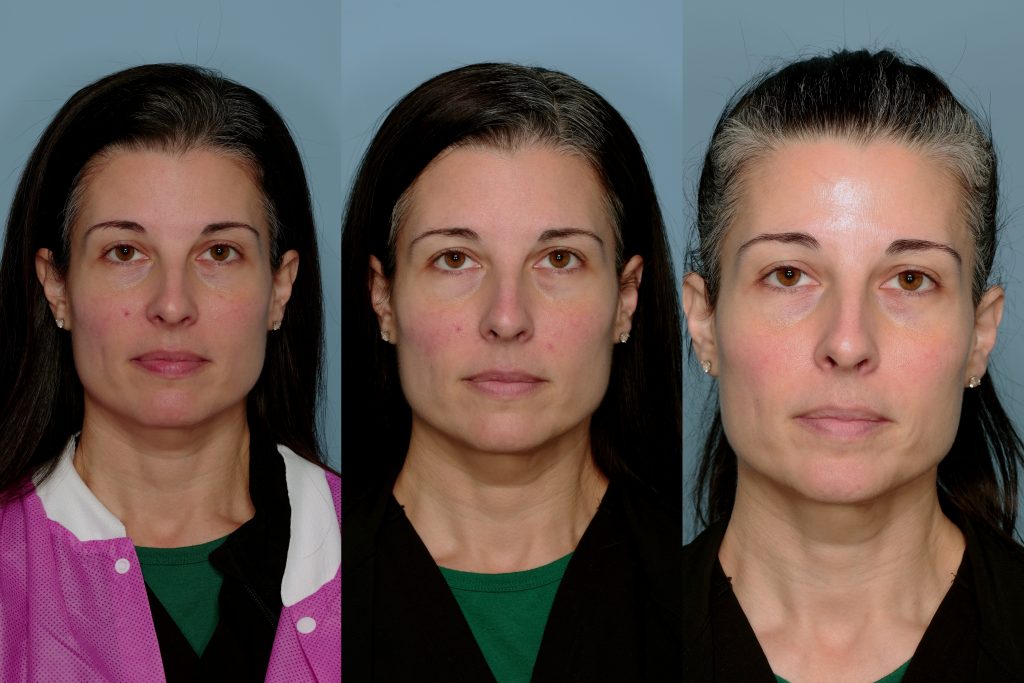 Real patient image before and after laser treatment.