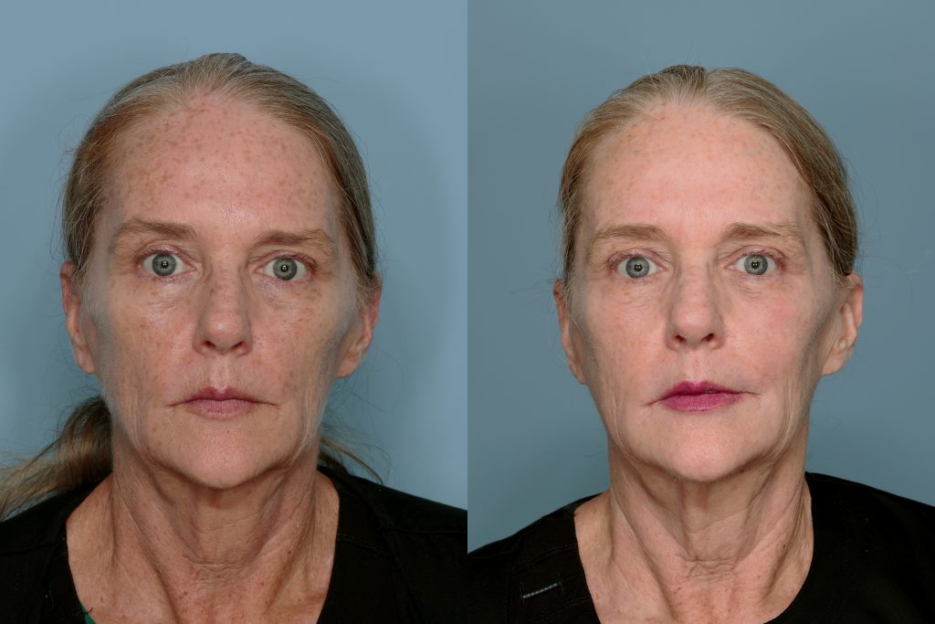 Real patient image before and after laser treatment.
