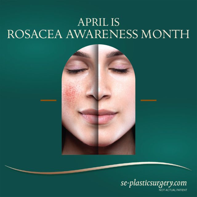 Each year, the National Rosacea Society (NRS) designates April as Rosacea Awareness Month to educate the public on the impact of this chronic and widespread facial disorder that is estimated to affect more than 16 million Americans.

Rosacea is a common concern that can make the skin look red and irritated. Laser treatments such as intense pulsed light (IPL) use controlled light in specific wavelengths to alleviate these issues. Treatment can smooth inflammation and reduce redness, pimples, and uneven skin tones. IPL is a popular option for combating rosacea as the results can last for 3 to 5 years. 💕

 Contact the SPA at SPS at 850.810.0964 or https://se-plasticsurgery-spa.com/med-spa-services/ipl-photofacial/ to schedule your consultation with one of our medical aestheticians. We will create a personalized rosacea treatment plan to help you find relief and improve the beauty of your skin.

#theSPAatSPS 
#Expertisematters 
#Rosacea 
#medicalSPA