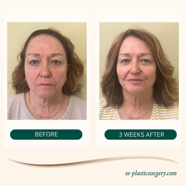 This beautiful patient came to us wanting to restore volume after recent weight loss, and the results speak for themselves! Using @restylaneusa filler, our expert injector, Jordan, addressed the midface, chin, and lips, smoothing shadows and enhancing her natural features for a refreshed, balanced look. 💉

Thinking about a similar transformation? Schedule a consultation to learn more by calling our office at 850.409.6353 or contacting Jordan directly at jhill@se-plasticsurgery.com.

#restylane #facialrejuvenation #facialfillers #beforeandafterweightloss #dermalfillerinjections #fillerresults #medspa #aesthetictreatment #glowup