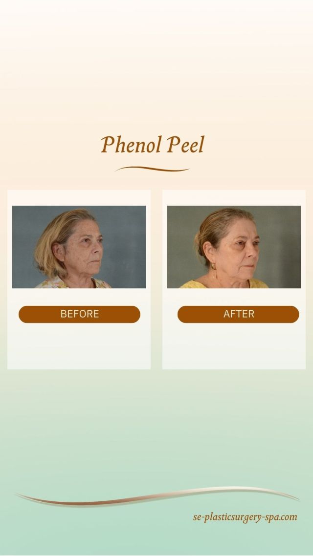 Wondering if a phenol peel is right for you? Dr. Rosenberg explains how a phenol peel can be tailored to meet your skin’s unique needs, whether you’re in your early 30s and looking for a light refresh or seeking a more intensive treatment for deep lines and discoloration.

Recently, he had a patient concerned with dark spots and fine lines but not ready for a facelift. Using a customized phenol peel, he was able to achieve significant improvements in her skin’s appearance. 

If you’re interested in learning more about phenol peels and what treatment might be right for your concerns, call our office at 850.409.6353 or schedule a consultation online via the link in bio.

#phenolpeel #skintransformation #skincarejourney #beforeandafter #skinrejuvenation #peelresults #medspatreatment #aestheticclinic #glowingskin #antiaging #youthfulskin #skincareexpert #darkspotcorrection #finelines #skincaregoals #medspalife #healthyskin #customizedpeel #radiantskin #expertisematters