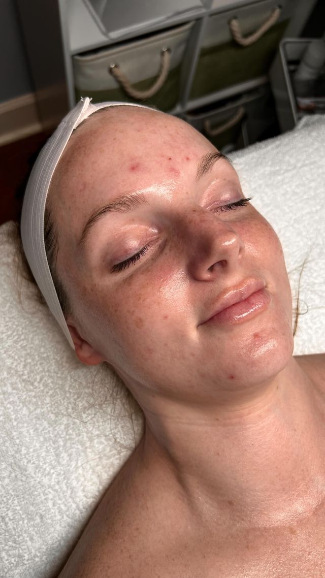 ✨ The Benefits of a Monthly Maintenance Facial ✨

Incorporating monthly facials into your skincare routine is an essential investment in your skin’s health and vitality. Here are the key benefits:

✨ Combat the signs of aging by strengthening your skin’s defenses against oxidative stress.
✨ Enhance circulation with targeted massage and oxygen treatments for a refreshed and rejuvenated complexion.
✨ Achieve an even skin tone through the use of chemical peels and advanced brightening products.
✨ Detoxify and purify with clay masks and extractions, leaving your skin deeply cleansed and refined.

Don’t miss out! For a limited time, enjoy 20% OFF our 25th Anniversary SPA gift cards during our exclusive online event beginning October 24th at 8 p.m. through November 4th. These gift cards can be used toward your monthly facials, allowing you to enjoy your treatments at a discounted rate.

To book a SPA appointment or if you have questions about our exclusive online event, call our office at 850.786.2659. 

#skincare #skincareroutine #skincaretips #facialcare #spafacial #tallahasseespa #expertisematters