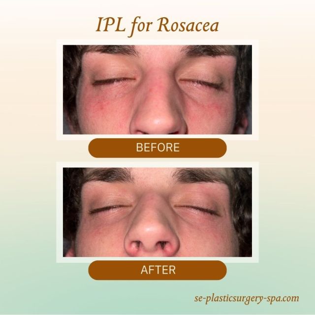 This patient came to us seeking a solution for the redness and visible capillaries caused by rosacea, and the difference is remarkable! Using IPL (Intense Pulsed Light) therapy, our expert aesthetician, Kris, effectively reduced redness and improved overall skin tone, revealing a clearer, more even complexion. 

If you want to address similar concerns or rejuvenate your skin, now is the perfect time. Schedule your services with Kris today through Friday, January 17th, and receive a complimentary gift—your choice of the ZO Intense Eye Crème or the ZO Get Ready Skin Kit (available while supplies last).

Call us at 850.219.2000 or visit the link in bio today to book your appointment.

#southeasternplasticsurgery #ipltreatments #iplfacialrejuvenation #rosacea #rosaceatreatment #medspatreatments #medspabeforeandafter #ipltreatment