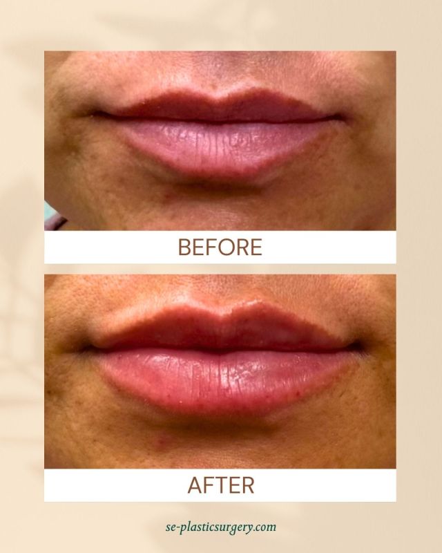 Subtle enhancements, stunning results. ✨

Before and after lip filler by our expert injector, Jordan, for a beautifully natural, fuller look. The goal? Enhance shape, restore balance, and maintain soft, natural movement—never overdone. 💉

Spring Break Special! Book with Jordan from March 10-14, and when you receive both Filler & Botox, you’ll get $100 off your treatment. 

Call us at 850.219.2000 to book your appointment today!

#lipfillerbeforeandafter #lipenhancement #naturallipfiller #lipaugmentation #lipfillerresults #fullerlips #expertinjector #lipfillerjourney #lipplump #lipgoals #liprejuvenation #lipfillertransformation #subtlelipfiller #balancedlips #hydratedlips #lipfillerexpert #naturallipenhancement #lipcontouring