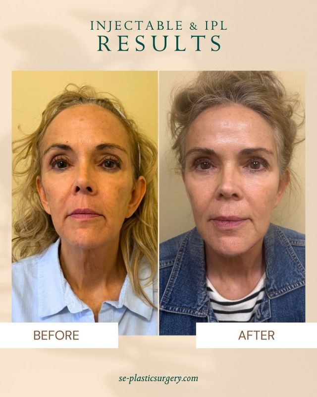 TRUST THE PROCESS

9 months of subtle injectables with our PA-C, Jordan! ✨

This patient trusted Jordan to create natural-looking results over time. Her treatment plan included:

💉 Full Face Botox (2x per year) to soften fine lines and maintain a refreshed look
💉 Filler (strategically placed over 3 appointments in the temples, cheeks, jawline, marionette lines, and lips) for natural contour and volume restoration
💧 Skinvive for deep hydration and improved skin smoothness
🔆 IPL treatment (one session) to refine skin pigmentation

With each appointment, subtle improvements built upon the last, leading to a beautifully refreshed and natural result.

Spring Break Special! Book with Jordan from March 10-14, and when you receive both Filler & Botox, you’ll get $100 off your treatment. Call our office at 850.219.2000 to book your appointment 💉

#botoxresults #botoxbeforeandafter #facialbalancing #injectablesexpert #naturalresults #expertisematters #botoxTallahassee #expertinjector #cheekfillerbeforeandafter #lipfillertransformation #jawlinefiller #fillerresults #iplbeforeandafter #iplresults #skinrejuvenation #skinviveglow #facialrejuvenation #glowupjourney #agegracefully #subtleenhancements