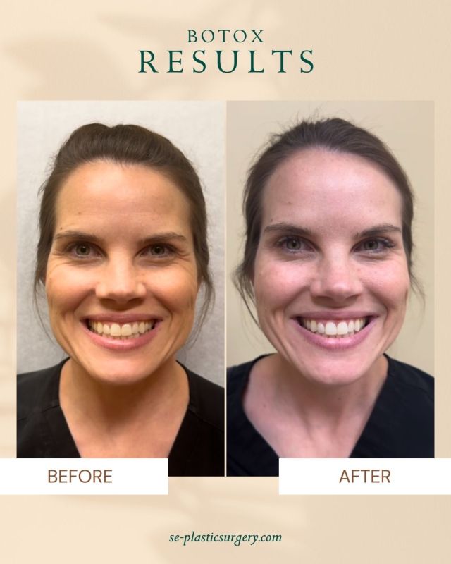 This patient received full-face Botox with our expert injector, Jordan, for a refreshed, smooth, and balanced appearance. Thoughtful Botox placement can soften lines, enhance facial harmony, and maintain natural movement—helping you look and feel your best. 💉

Spring Break Special! Book with Jordan from March 10-14, and when you receive both Filler & Botox, you’ll get $100 off your treatment.

Call us at 850.219.2000 to book your appointment today!

#botoxbeforeandafter #botoxresults #expertinjector #naturalbotox #botoxtransformation #botoxsmooth #botoxglow #botoxspecialist #preventativebotox #botoxfacialbalancing #botoxrefresh #subtlebotox #botoxforehead #botoxforwrinkles #botoxworks #botoxclinic #antiagingtreatment #botoxlifestyle #botoxskincare #botoxinjections