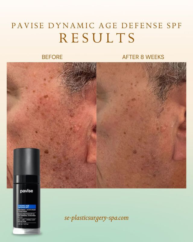 The results speak for themselves! Pavise Dynamic Age Defense SPF, is next-generation treatment that not only shields your skin from future damage, but also works to reverse signs of aging at the cellular level.

Formulated with patented DNA repair enzymes and powerful mineral filters, Pavise is ideal for:

✔ Anyone concerned with fine lines, age spots, or dullness
✔ Those with a history of sun exposure or sun damage
✔ Sensitive skin types looking for non-irritating, effective protection
✔ Patients post-procedure who want gentle yet powerful defense
✔ Anyone looking to prevent premature aging and preserve a radiant, youthful complexion

Results can be seen in as little as 8 weeks—with continued improvement over time.

Now available to purchase in-office or online at se-plasticsurgery-spa.com.

📍2030 Fleischmann Rd, Tallahassee, FL 32308

#pavise #spfskincare #paviseskin #sunprotectiontips #southeasternplasticsurgery #tallahasseeskincare #tallahasseebeauty #medspaflorida