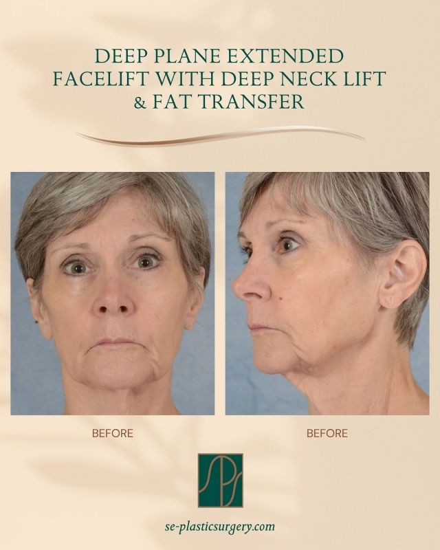 This patient’s surgical journey with Dr. Kirbo began with a brachioplasty, also known as an arm lift. She wanted to restore a smoother, more contoured look to her arms, and the results gave her the confidence to take the next step in her rejuvenation goals.

Several months later, she returned for facial rejuvenation, which included:

✅ Deep plane extended facelift
✅ Deep neck lift
✅ Fat transfer 

➡️ Swipe through to see her journey:
• Before and 4 weeks following her facelift, neck lift & fat transfer
• Her beautiful arm lift results from her earlier procedure

At just 4 weeks post-op, her face already shows a refreshed, youthful appearance that looks natural and true to her.