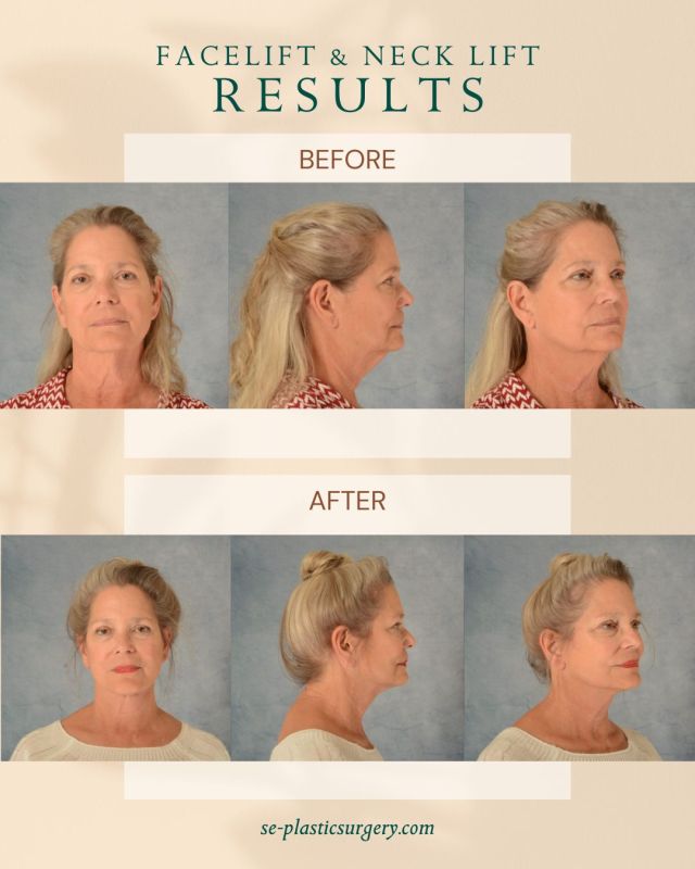 Did you know there are benefits to combining other plastic surgery procedures with a facelift?

Combining other plastic surgery procedures with a facelift provides more balanced and comprehensive rejuvenation by addressing multiple signs of aging in a single, coordinated plan. 

When you combine treatments that target different areas of the face, you achieve harmonious results from every angle while enjoying one recovery period.

If you’re considering a facelift, pairing it with strategic add-on procedures can help you achieve a smoother jawline, a brighter eye area, and more youthful facial volume. 

You can find some more benefits of pairing procedures and find out the most common combinations for fully refreshed, natural-looking results on our website at https://www.se-plasticsurgery.com/blog/what-are-the-benefits-of-combining-other-plastic-surgery-procedures-with-a-facelift/