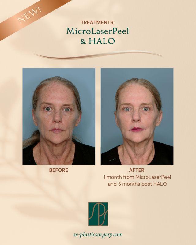 REVEAL YOUR SKIN'S NATURAL GLOW 
HALO is the world’s only Hybrid Fractional Laser that delivers a non-ablative and an ablative wavelength. ✨Ablative wavelengths target and treat the skin for surface-level conditions such as textural issues and pore size. 
✨The non-ablative wavelength targets deeper sun damage and other dermal pigmentary issues.

With minimal downtime, HALO is the ideal treatment for:
 ~ Fine Lines & Wrinkles
 ~ Sun damage & Dyschromia
 ~ Acne Scars
~ Signs of Aging
~ Pigmented Lesions
~ Enlarged Pores

From targeted pigment correction to full-face revitalization, our latest advanced skin treatments offer safe, effective ways to refresh your look without surgery. Call us at (850) 296-0379 or LINK in BIO to request a consultation with our experienced team to discover which option is best for your skin goals

LEARN MORE at https://se-plasticsurgery-spa.com/blog/halo-and-bbl-by-sciton-advanced-skin-treatment-faqs/

#theSPAatSPS