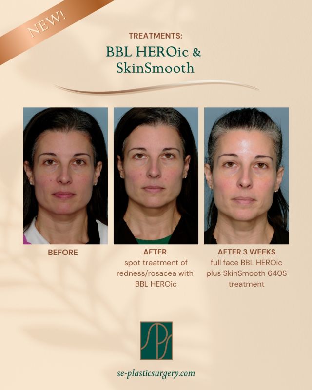 BBL HEROic
Meet the world’s smartest pulsed light device BBL HEROic. This treatment revitalizes and restores skin, stimulates cell regeneration, treats pigment and vascular issues all while enhancing skin tone and texture. May be used on the face or body.

NO DOWN TIME and great for treating:
Freckles
Age Spots
Cherry Angiomas 
Rosacea 
Dull Complexion 
Acne and Unwanted Hair
Appearance of Skin Laxity

Call us at (850) 219-2000 or LINK in BIO  to request a consultation with our experienced team to discover which option is best for your skin goals
LEARN MORE at our website BLOG 
#thespaatsps
#SPSperks 
#bblheroic