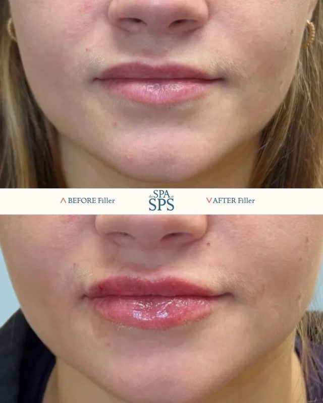 At @thespa_sps injectable treatments can be customized to enhance lip shape, volume and balance while maintaining natural-looking proportions.

Treatment plans are based on individual anatomy and aesthetic goals! 

Book your consultation in our link in bio!